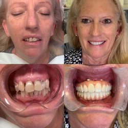 Ryan Dunlop, DMD - Better Life Dentistry - Remarkable change! One 2 weeks apart from bad teeth to new implants!!
