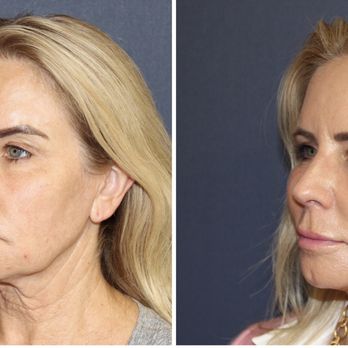 David A. Bray, Jr., M.D - Before and after facelift - Cosmetic Surgeons Near Me - Torrance, California