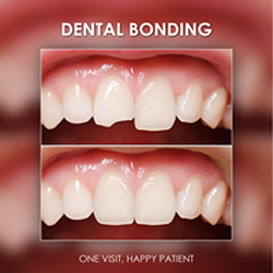 Port Arthur Smiles - Dental Bonding Port Arthur Smiles