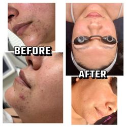 KM Esthetics - Acne treatment