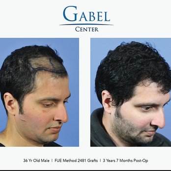 Gabel Center - The difference that this #2481 graft #FUE #hairtransplant by Dr. Gabel has made in this patient's life is remarkable! - Hair Loss Centers Near Me - Portland, Oregon Gabel Center - The difference that this #2481 graft #FUE #hairtransplant by Dr. Gabel has made in this patient's life is remarkable! - Hair Loss Centers Near Me - Portland, Oregon