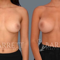 Barrett Plastic Surgery - Bilateral Mentor Moderate Profile Plus Smooth Silicone

300cc right, 275cc left