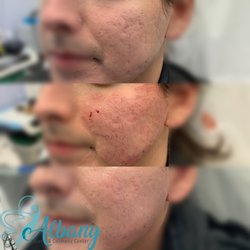 Albany Cosmetic & Laser Centre - Acne Scar Treatment