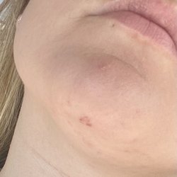 Radiant Waxing Coeur d'Alene - Chin wax issue