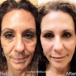 Masri Clinic for Laser and Cosmetic Surgery - A beautiful before and after transformation of a liquid facelift!