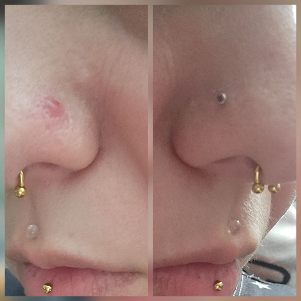 Wildside Tattoo - Both done 2 days apart, had to remove the one done by wildside because of the bump pictured. The right was Body Piercings by Jackie. - Tattoo Near Me - Myrtle Beach, South Carolina Wildside Tattoo - Both done 2 days apart, had to remove the one done by wildside because of the bump pictured. The right was Body Piercings by Jackie. - Tattoo Near Me - Myrtle Beach, South Carolina