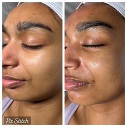 Fadia Beauty - Acne treatment