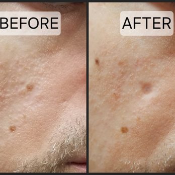 Hooman Khorasani, M.D - Before and after comparison. Photos taken one year apart. - Cosmetic Surgeons Near Me - New York, New York