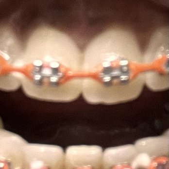 DentalWorks - The tooth is longer than the other and starting to shift - General Dentistry Near Me - Indianapolis, Indiana DentalWorks - The tooth is longer than the other and starting to shift - General Dentistry Near Me - Indianapolis, Indiana