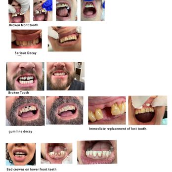 Clifford D. Kerr D.D.S. - Before and Afters - General Dentistry Near Me - Lodi, California Clifford D. Kerr D.D.S. - Before and Afters - General Dentistry Near Me - Lodi, California