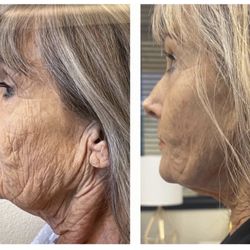 Dermacare Non-Surgical Face & Body Sculpting - Better than a surgical facelift. A fraction of the cost, no surgery, no downtime, no scarring.