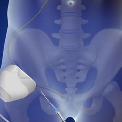 US Pain Clinic - Nerve block under ultrasound guidance