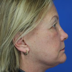 Robert J Paresi,  MD - 69 year-old patient 5 weeks after facelift