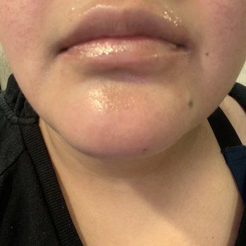 A.J. Khalil, MD - My before - Cosmetic Surgeons Near Me - Beverly Hills, California