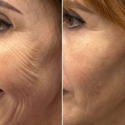 Struktur Studio - Sylfirm plus IPl 3 treatments later..
https://www.strukturstudio.ca/total-skin-transformation-why-ipl-sylfirm-x-is-the-ultimate-power-duo