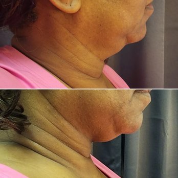 Suite Sculpt 35 - Radio Frequency on the Chin area - Body Contouring Near Me - Irving, Texas Suite Sculpt 35 - Radio Frequency on the Chin area - Body Contouring Near Me - Irving, Texas