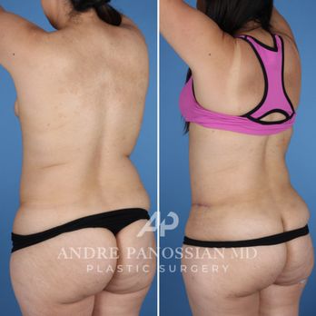 Andre Panossian, MD - Tummy tuck - Cosmetic Surgeons Near Me - Pasadena, California Andre Panossian, MD - Tummy tuck - Cosmetic Surgeons Near Me - Pasadena, California