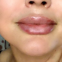 Lip flip w filler Lip flip w filler