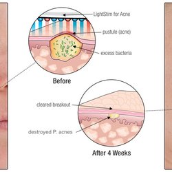 Hello Gorgeous! Aesthetics by Veronica - Retailed Light Stim Blue Light Therapy reduces acne and scaring.