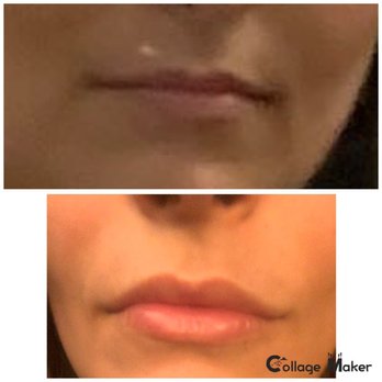Nubo Spa - Before and after photo - Medical Spas Near Me - Berkeley, California