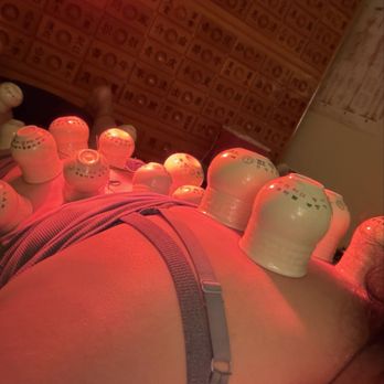 Zen Acupuncture - Cupping and acupuncture session. - Acupuncture Near Me - Norco, California