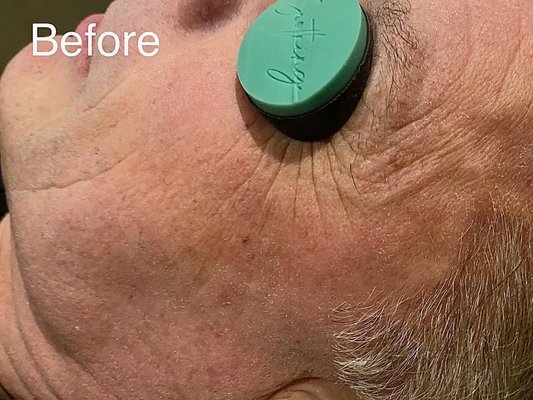 Hydration facial to combat severe dryness - Client came in with severely dry skin and redness. After one treatment his skin looks much healthier and no more inflammation. Lines around the eyes are less visible. Hydration facial to combat severe dryness - Client came in with severely dry skin and redness. After one treatment his skin looks much healthier and no more inflammation. Lines around the eyes are less visible.