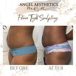 Angel Aesthetics Med spa - Before & after with just ONE session of the Fotona Tight Sculpting