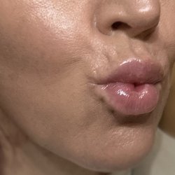 Duluth Med Spa - Lips and cheek filler