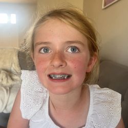 Kensington Pediatric Dentistry - 1st day with braces