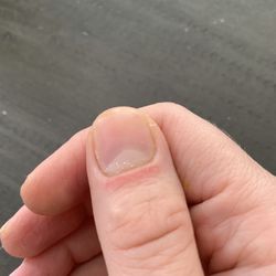Premier Nails - Cut up skin around my nail bed from the nail technician prepping my nails with a drill