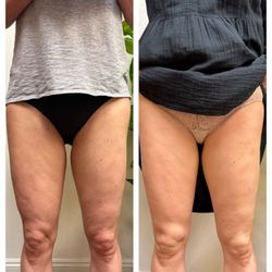 Time to Shine Studio - Endospheres Cellulite Treatment and Skin Tightening