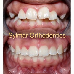 Sylmar Orthodontics - Dental Crowding treated with Invisalign!