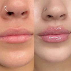 Joyfulipss Aesthetics - 1ml was distributed into her lips, with the hyaluron pen method.
Subtle results with long lasting longevity