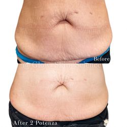 Glow Skin Science - Potenza RF Microneedling