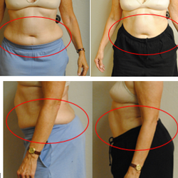 Luna Therapy - Non-surgical lipo laser for targeted fat loss and inch reduction. Painless, non-invasive, and no downtime!