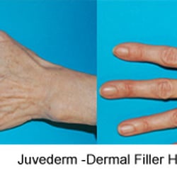 Aesthetica Skin Health Center - Dermal Fillers can be used to replenish hands