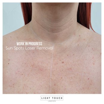 Light Touch Laser Spa - Sun Spots Laser Removal - Light Touch Laser Spa NYC - Laser Hair Removal Near Me - New York, New York Light Touch Laser Spa - Sun Spots Laser Removal - Light Touch Laser Spa NYC - Laser Hair Removal Near Me - New York, New York