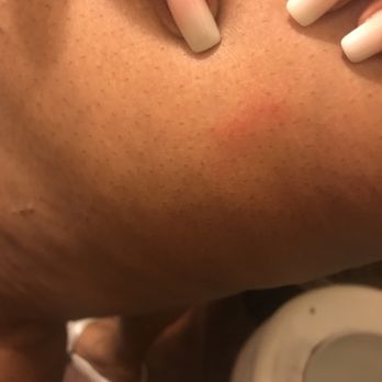 Spring Spa - Bed bug bites/ insect bites from sheets/ location. - Day Spas Near Me - Las Vegas, Nevada Spring Spa - Bed bug bites/ insect bites from sheets/ location. - Day Spas Near Me - Las Vegas, Nevada