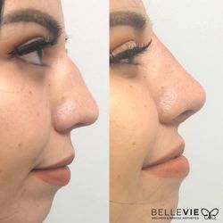 Non surgical nose job