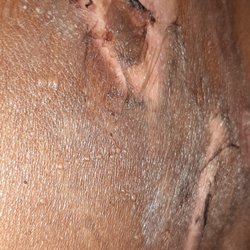 Exer Urgent Care - Rancho Palos Verdes - My burns a couple of weeks after fainting
