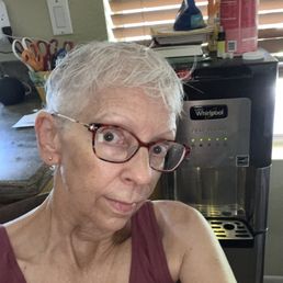 This is all the hair affected by alopecia. Mindy made it look so much healthier! This is all the hair affected by alopecia. Mindy made it look so much healthier!
