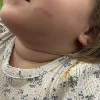 Sunrise Preschools - Bite mark - Child Care & Day Care Near Me - Surprise, Arizona