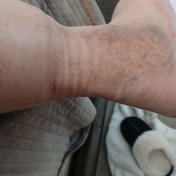 Bay Area Foot Care - Anvle - Podiatrists Near Me - Castro Valley, California Bay Area Foot Care - Anvle - Podiatrists Near Me - Castro Valley, California