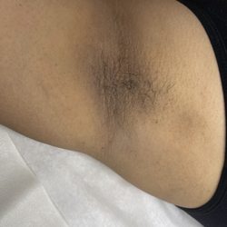 Bare Skin By Liz - Before Underarm Wax.