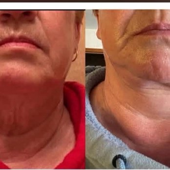 Lyle M Back, MD - This is my before and after. Red shirt is before. Dr. Lyle Back did this. He refuses to look at my pictures and thinks he did a good job. - Cosmetic Surgeons Near Me - Cherry Hill, New Jersey Lyle M Back, MD - This is my before and after. Red shirt is before. Dr. Lyle Back did this. He refuses to look at my pictures and thinks he did a good job. - Cosmetic Surgeons Near Me - Cherry Hill, New Jersey