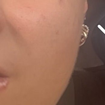 Princess Nails - My skin before the facial. - Nail Salons Near Me - Long Beach, California Princess Nails - My skin before the facial. - Nail Salons Near Me - Long Beach, California