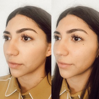 Modern SLC Injections & Aesthetics - We balanced it out my face - Medical Spas Near Me - Holladay, Utah Modern SLC Injections & Aesthetics - We balanced it out my face - Medical Spas Near Me - Holladay, Utah