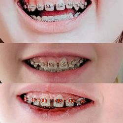 Commonwealth Orthodontics - Top photo: Installation Day Second Photo: 1 month 3rd Photo: 2 months