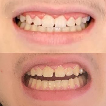 Diamond Dental Group - Bottom is current top is right after braces removed. - General Dentistry Near Me - Las Vegas, Nevada Diamond Dental Group - Bottom is current top is right after braces removed. - General Dentistry Near Me - Las Vegas, Nevada