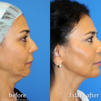 Bella Tu Med Spa - Y LIFT Before & After Sarah Lazarus is a Certified Y LIFT Provider. Schedule your consult today! - Medical Spas Near Me - Nyack, New York Bella Tu Med Spa - Y LIFT Before & After Sarah Lazarus is a Certified Y LIFT Provider. Schedule your consult today! - Medical Spas Near Me - Nyack, New York